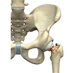 Treatment of Valgus-Impacted and Nondisplaced Femoral Neck Fragility Fractures in the Elderly